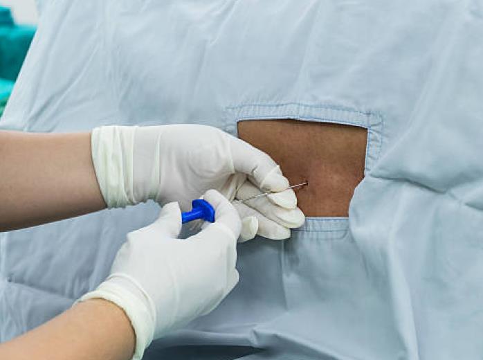 Spinal Anesthesia